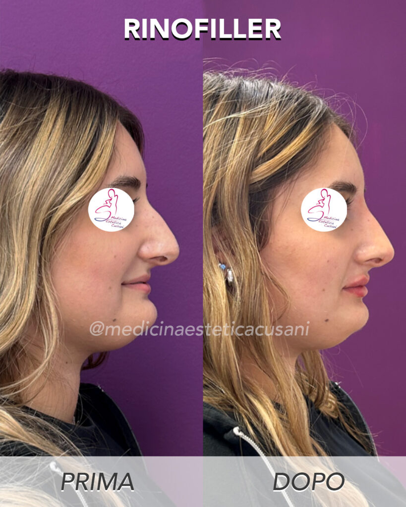 Rinofiler Clinica per trattamenti di medicina estetica a Monza e Brianza