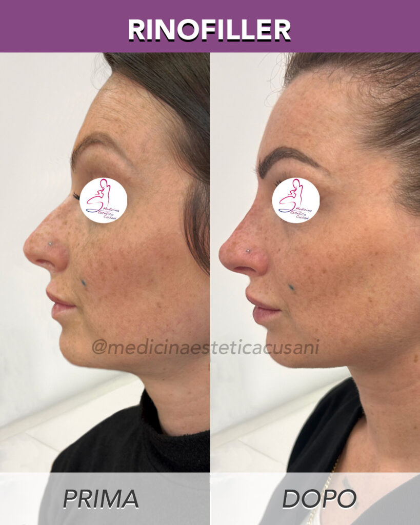 Rinofiller2 Lifting non chirurgico a Carate Brianza